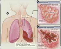 నిమోనియాను నివారిద్దాం..
